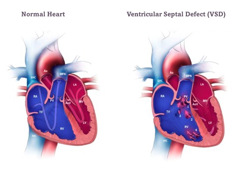 Ventricular-Septal-Defect