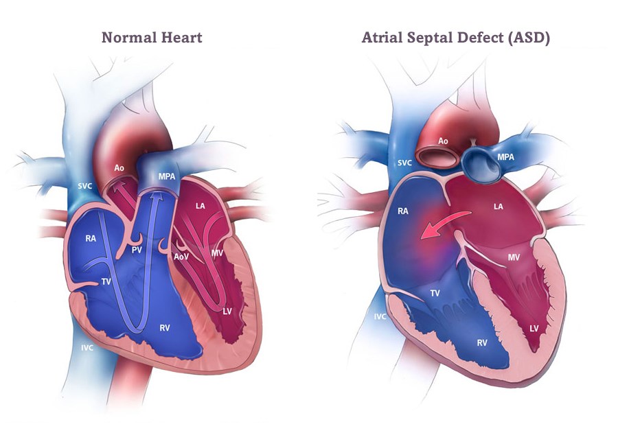 Atrial-Septal-Defect