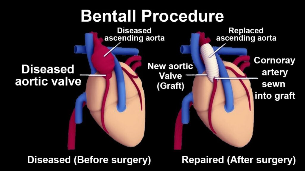 Bentall-Procedure