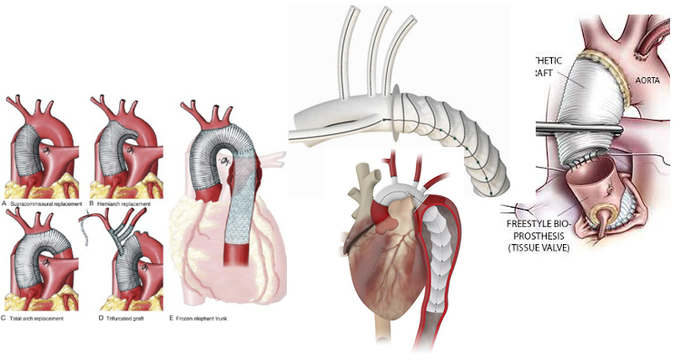 Heart-Surgery